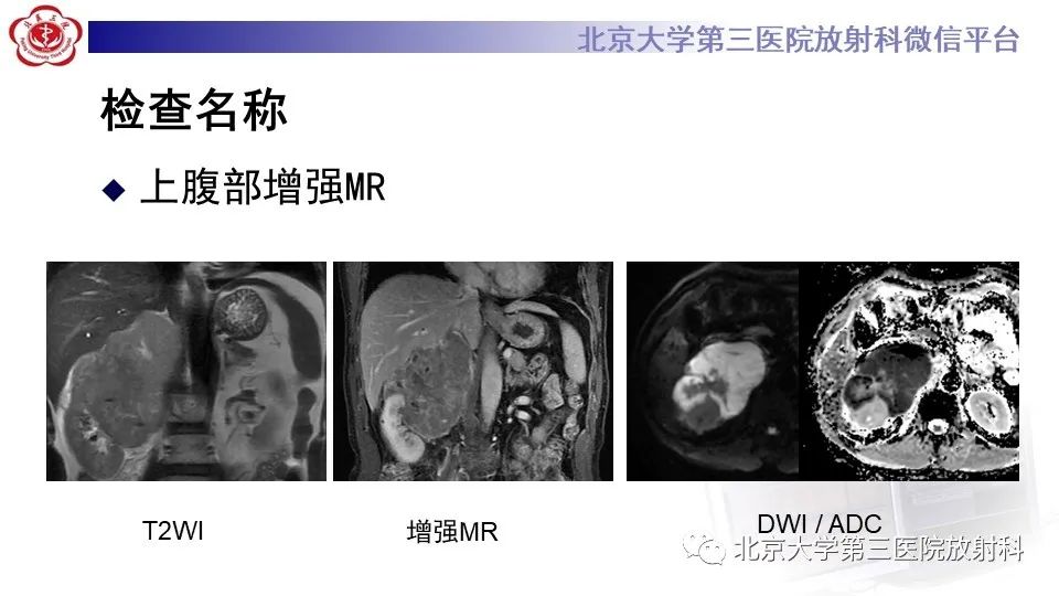 影像PPT - 【PPT】原发性肾上腺淋巴瘤-6