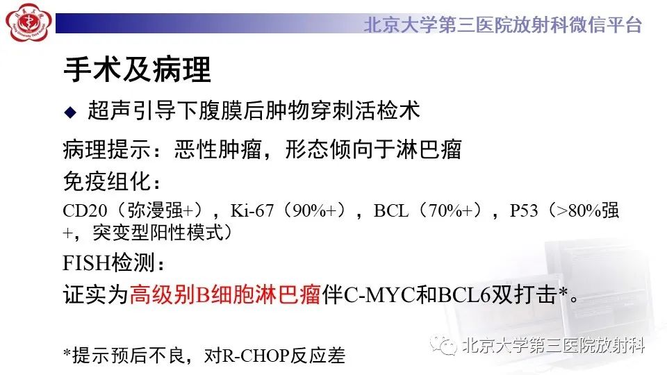影像PPT - 【PPT】原发性肾上腺淋巴瘤-8