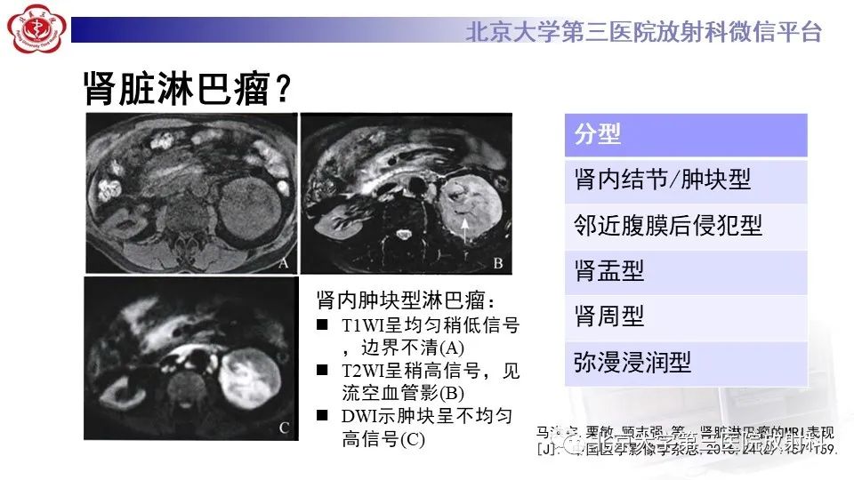 影像PPT - 【PPT】原发性肾上腺淋巴瘤-9