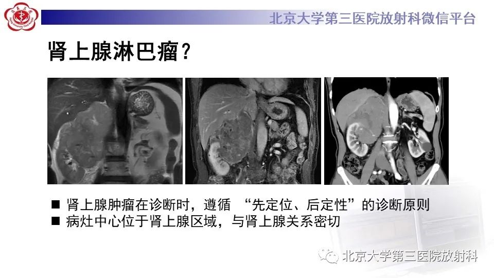 影像PPT - 【PPT】原发性肾上腺淋巴瘤-10