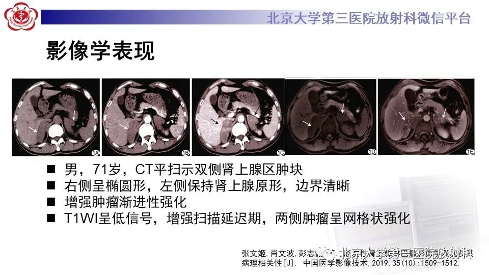 影像PPT - 【PPT】原发性肾上腺淋巴瘤-17