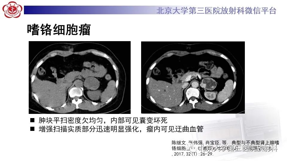 影像PPT - 【PPT】原发性肾上腺淋巴瘤-19