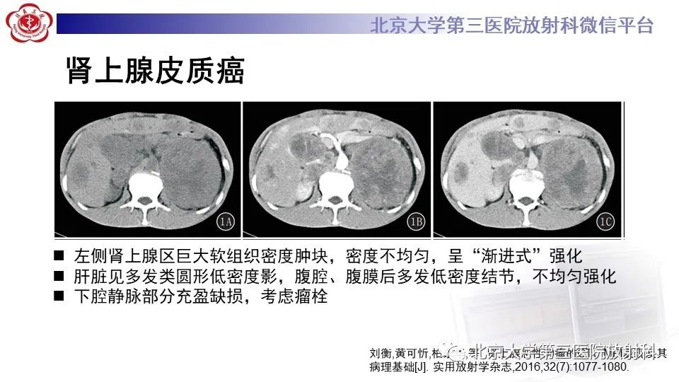 影像PPT - 【PPT】原发性肾上腺淋巴瘤-20