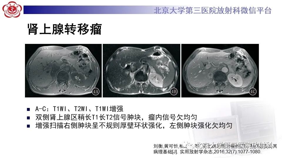 影像PPT - 【PPT】原发性肾上腺淋巴瘤-21