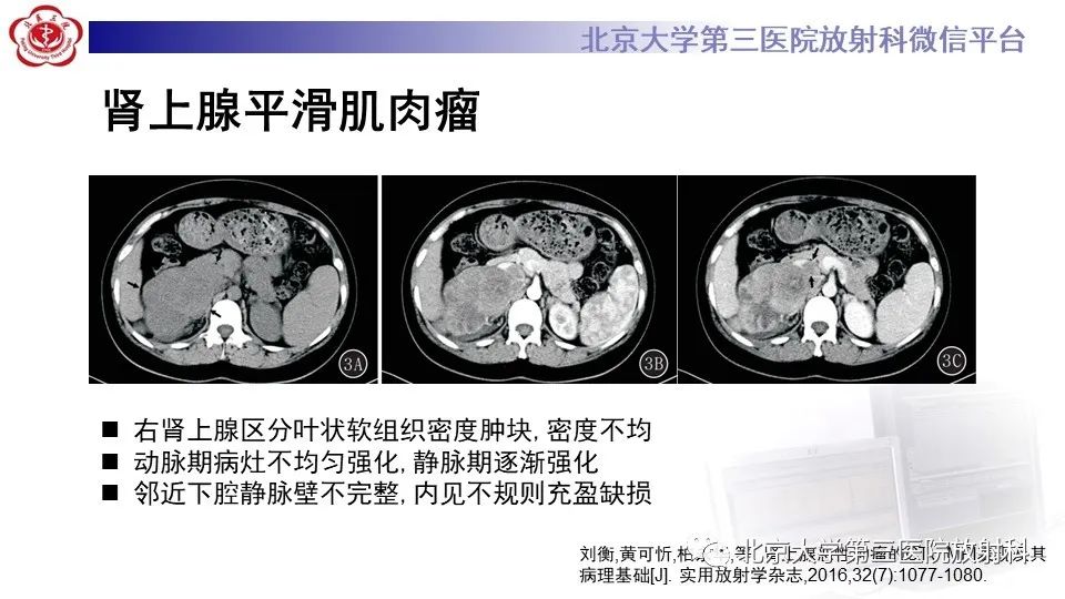 影像PPT - 【PPT】原发性肾上腺淋巴瘤-22