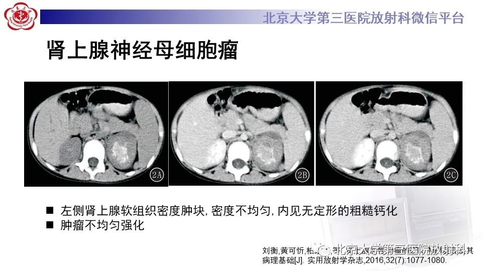 影像PPT - 【PPT】原发性肾上腺淋巴瘤-23