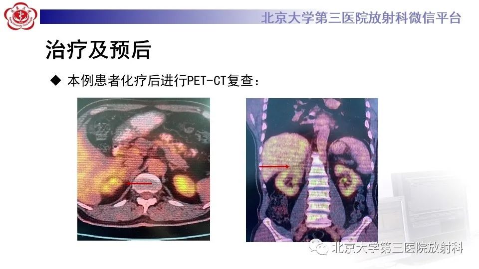 影像PPT - 【PPT】原发性肾上腺淋巴瘤-25