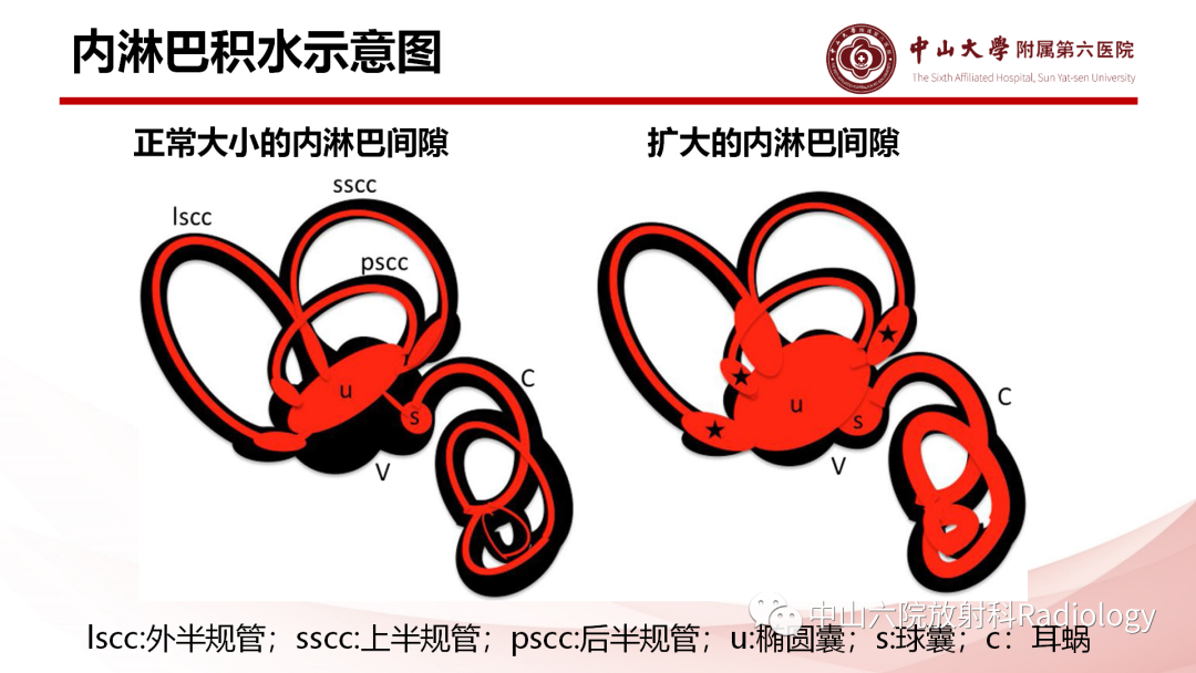 影像PPT - 【PPT】梅尼埃病的影像学诊断-6