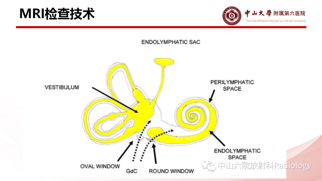 影像PPT - 【PPT】梅尼埃病的影像学诊断-11