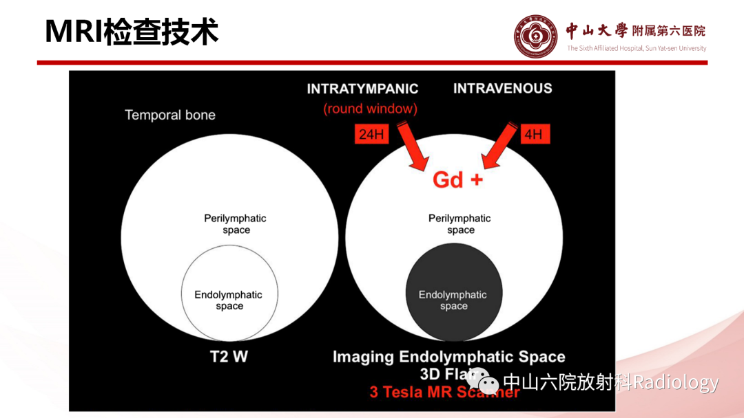 影像PPT - 【PPT】梅尼埃病的影像学诊断-12