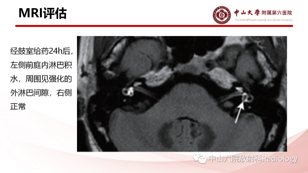影像PPT - 【PPT】梅尼埃病的影像学诊断-15