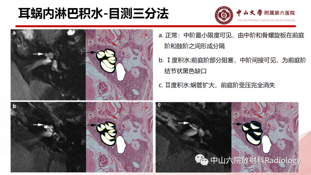 影像PPT - 【PPT】梅尼埃病的影像学诊断-18