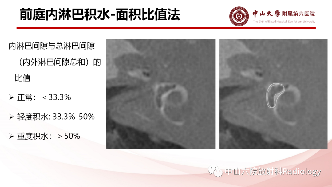 影像PPT - 【PPT】梅尼埃病的影像学诊断-20