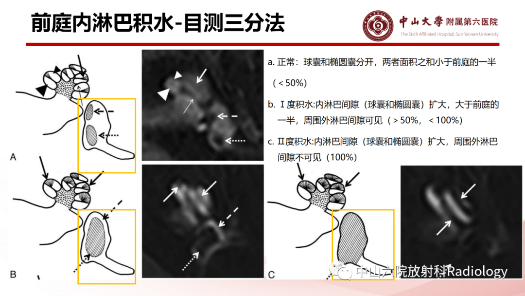 影像PPT - 【PPT】梅尼埃病的影像学诊断-21