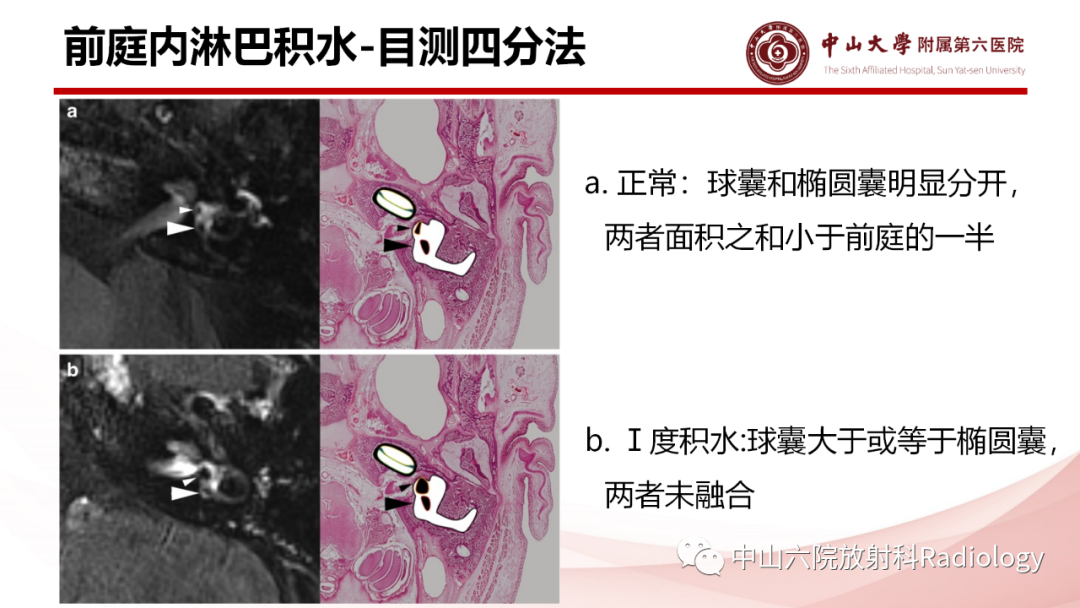 影像PPT - 【PPT】梅尼埃病的影像学诊断-22