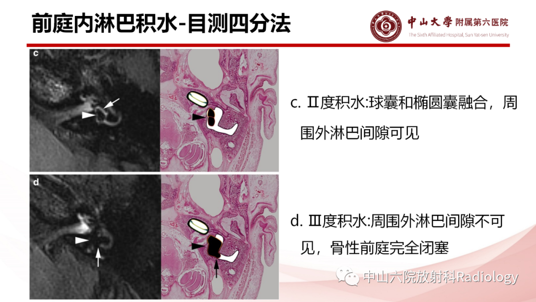 影像PPT - 【PPT】梅尼埃病的影像学诊断-23