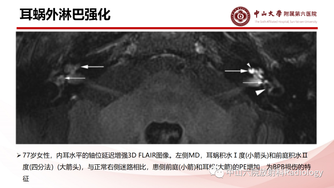 影像PPT - 【PPT】梅尼埃病的影像学诊断-25