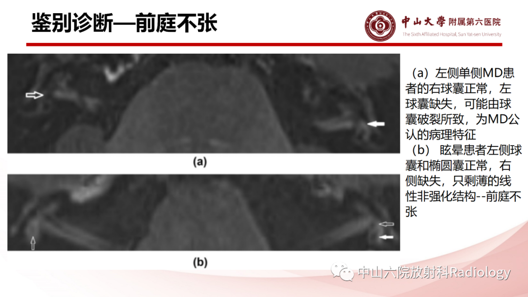 影像PPT - 【PPT】梅尼埃病的影像学诊断-27
