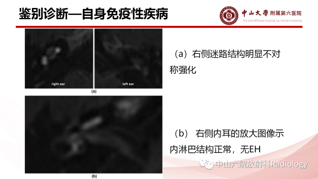 影像PPT - 【PPT】梅尼埃病的影像学诊断-28