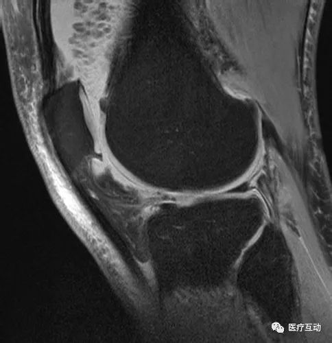 影像PPT - 【病例】膝关节树枝状脂瘤1例MR影像-6