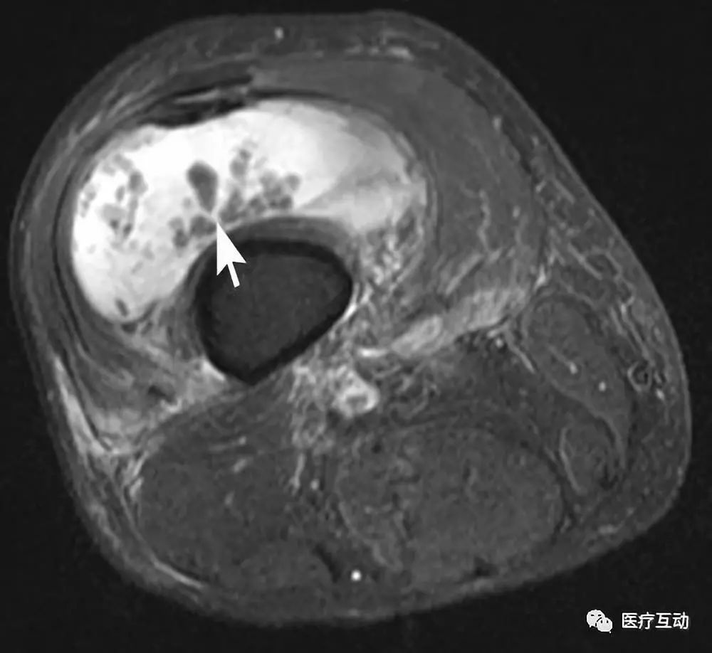 影像PPT - 【病例】膝关节树枝状脂瘤1例MR影像-7