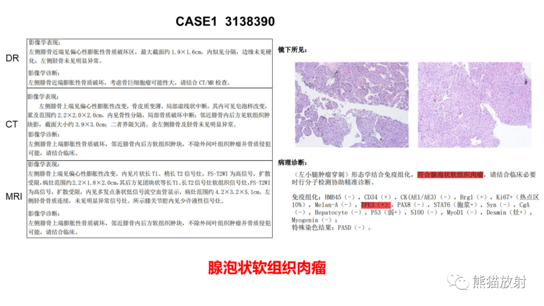 影像PPT - 【病例】小腿腺泡状软组织肉瘤 VS 黏液样脂肪肉瘤-24