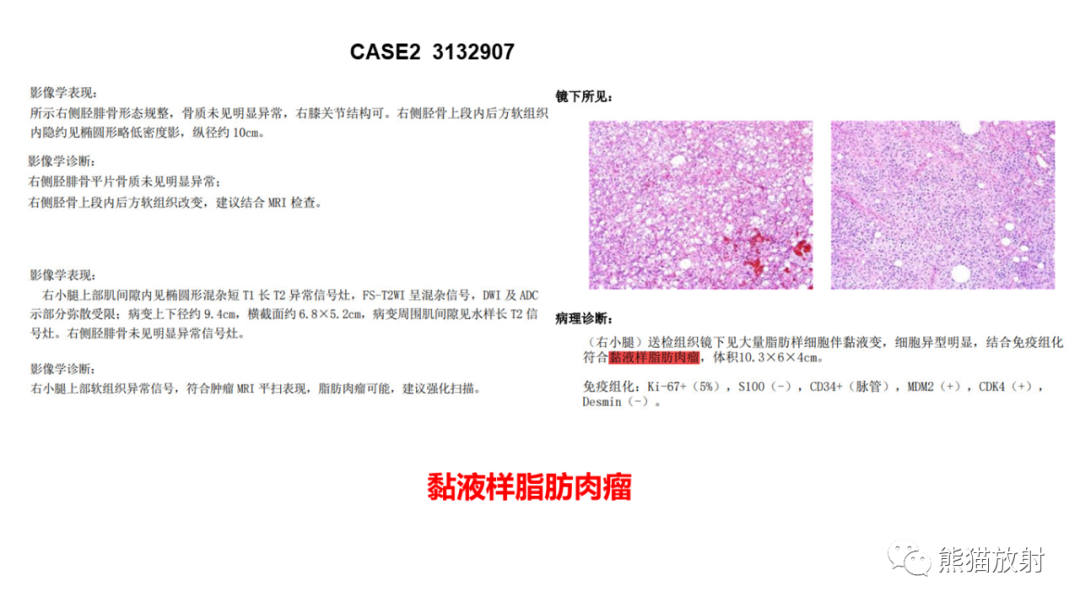 影像PPT - 【病例】小腿腺泡状软组织肉瘤 VS 黏液样脂肪肉瘤-25