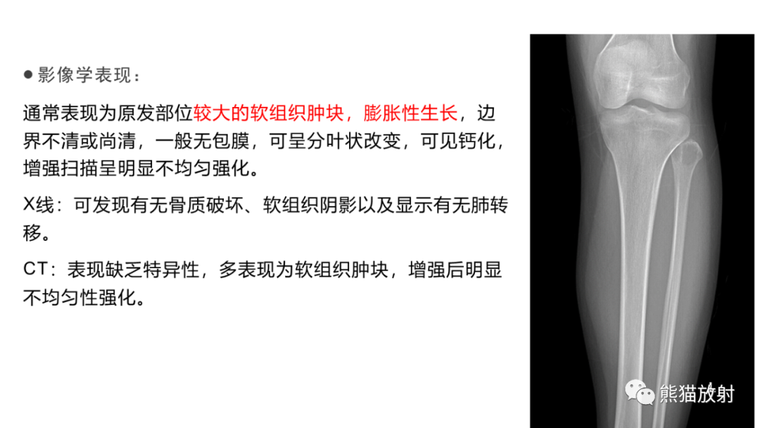 影像PPT - 【病例】小腿腺泡状软组织肉瘤 VS 黏液样脂肪肉瘤-29