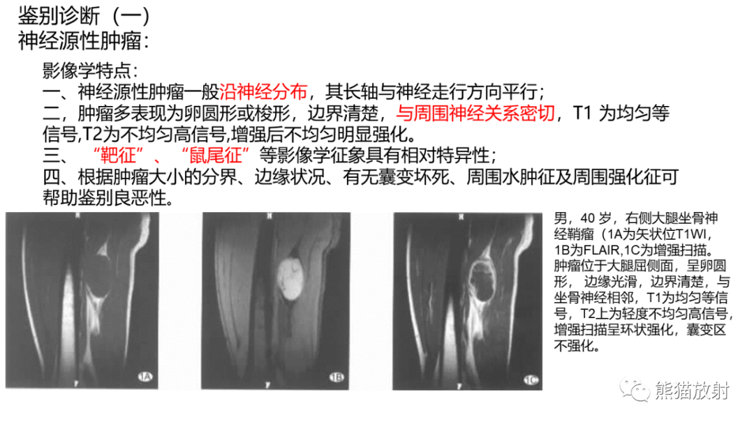 影像PPT - 【病例】小腿腺泡状软组织肉瘤 VS 黏液样脂肪肉瘤-34