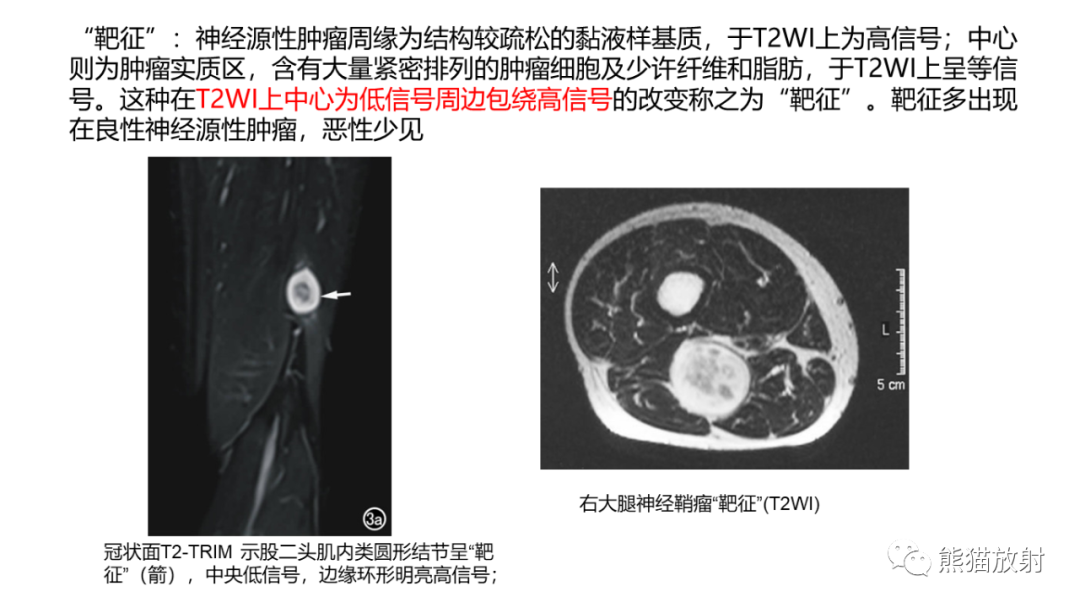 影像PPT - 【病例】小腿腺泡状软组织肉瘤 VS 黏液样脂肪肉瘤-35