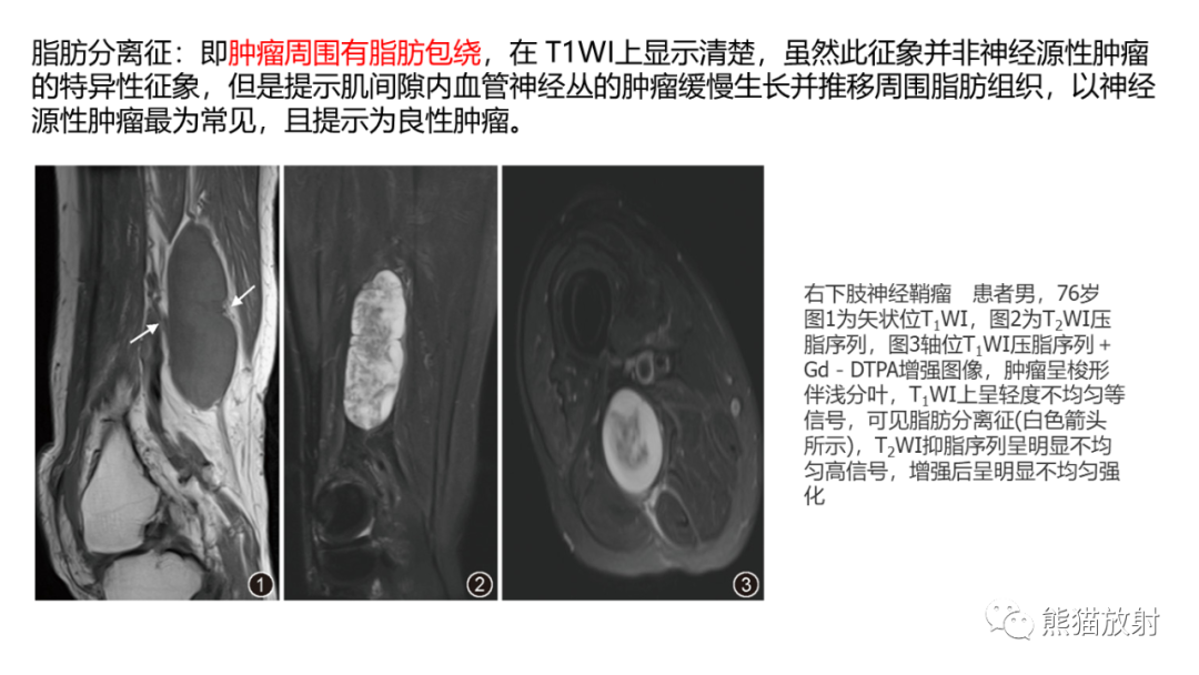 影像PPT - 【病例】小腿腺泡状软组织肉瘤 VS 黏液样脂肪肉瘤-36