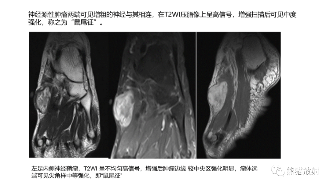 影像PPT - 【病例】小腿腺泡状软组织肉瘤 VS 黏液样脂肪肉瘤-37