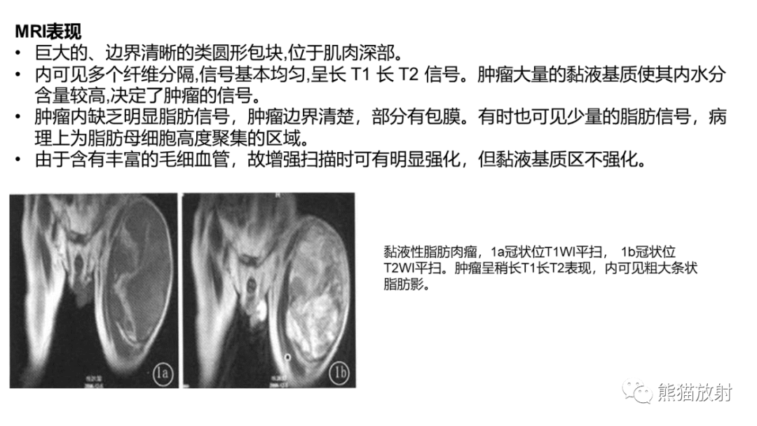 影像PPT - 【病例】小腿腺泡状软组织肉瘤 VS 黏液样脂肪肉瘤-41