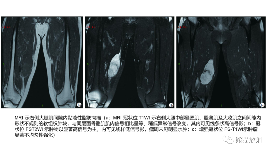 影像PPT - 【病例】小腿腺泡状软组织肉瘤 VS 黏液样脂肪肉瘤-42