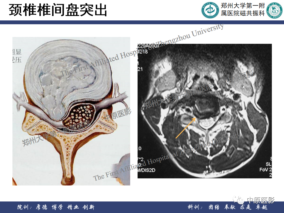 影像PPT - 【PPT】磁共振在颈椎病中的应用-12