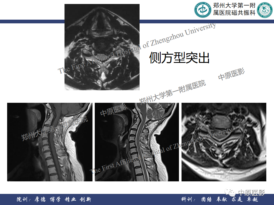 影像PPT - 【PPT】磁共振在颈椎病中的应用-15