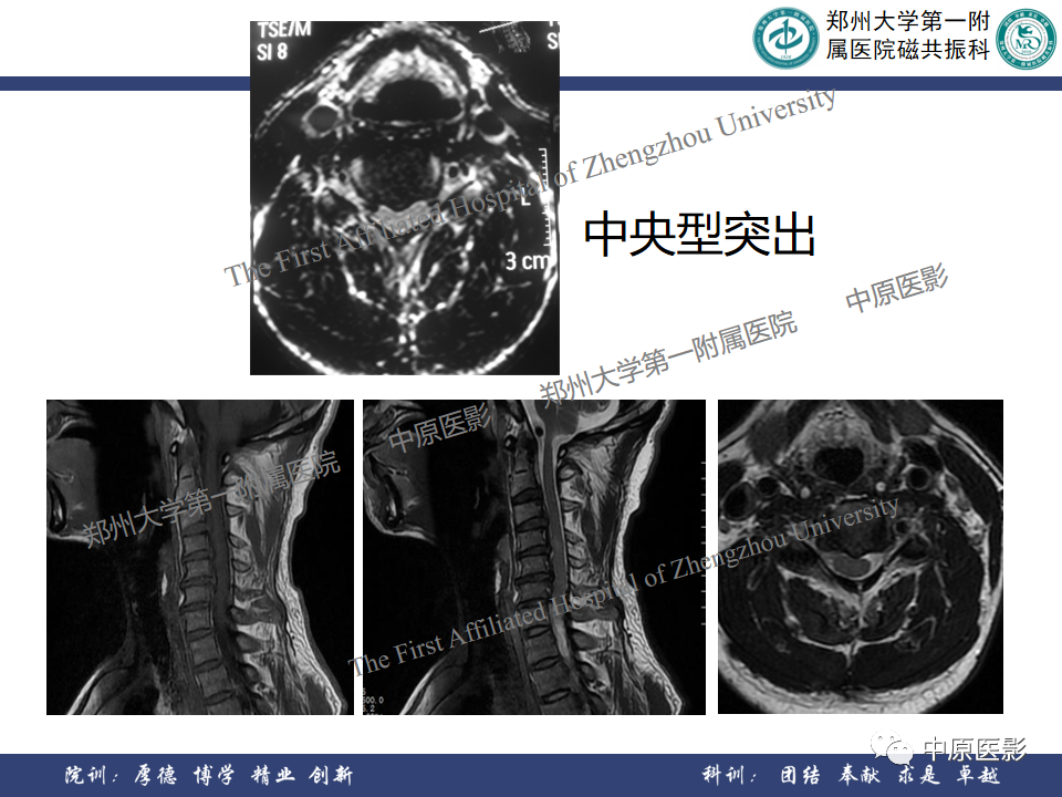 影像PPT - 【PPT】磁共振在颈椎病中的应用-14