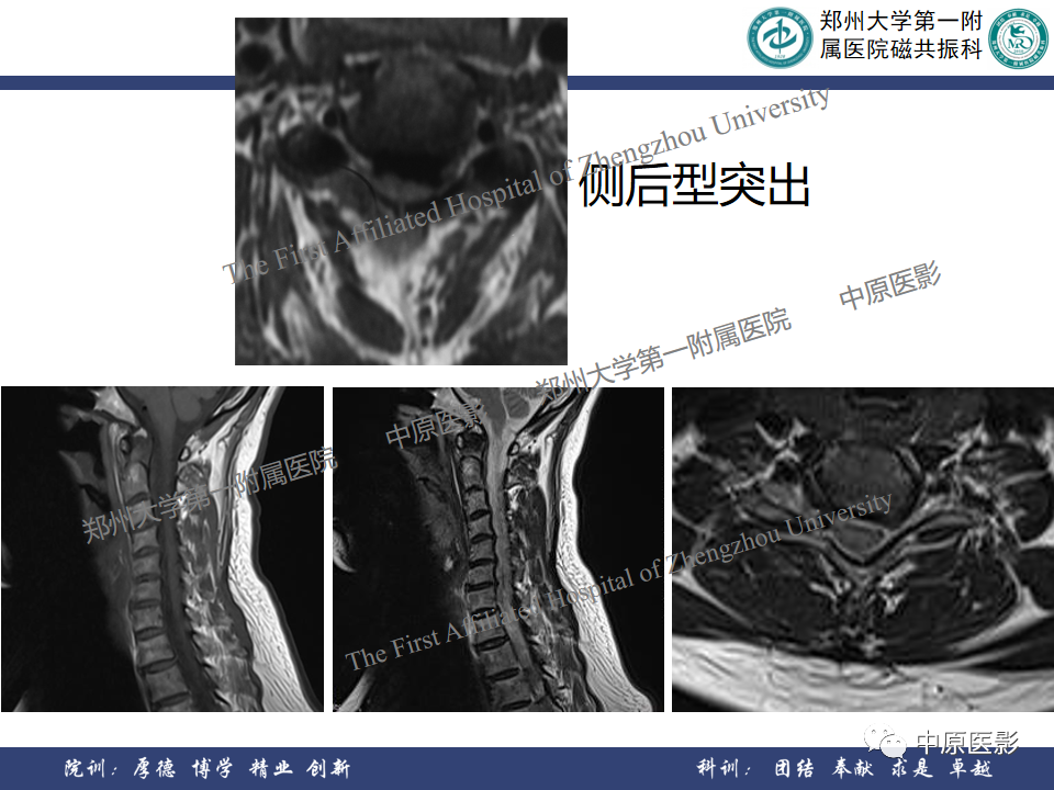 影像PPT - 【PPT】磁共振在颈椎病中的应用-16