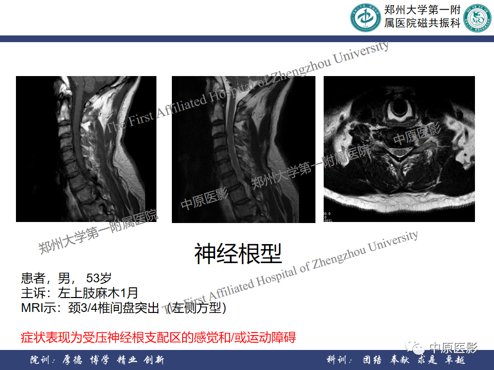 影像PPT - 【PPT】磁共振在颈椎病中的应用-18