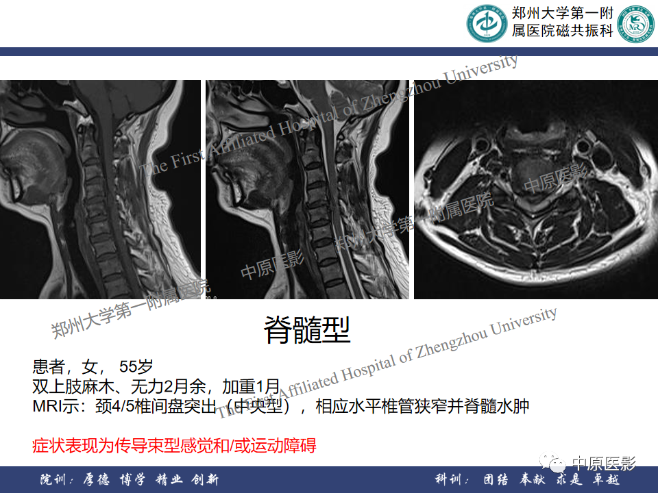 影像PPT - 【PPT】磁共振在颈椎病中的应用-20