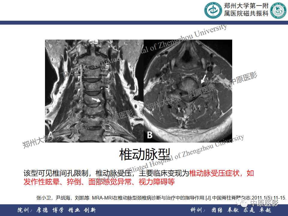 影像PPT - 【PPT】磁共振在颈椎病中的应用-19