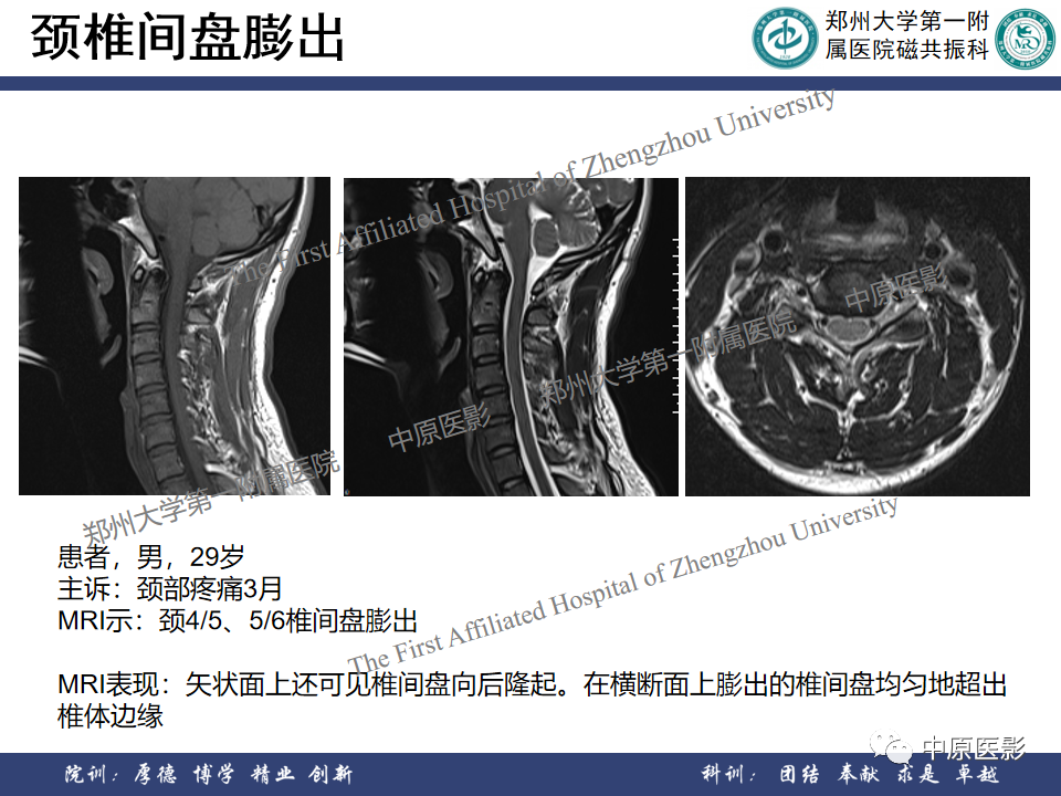 影像PPT - 【PPT】磁共振在颈椎病中的应用-24
