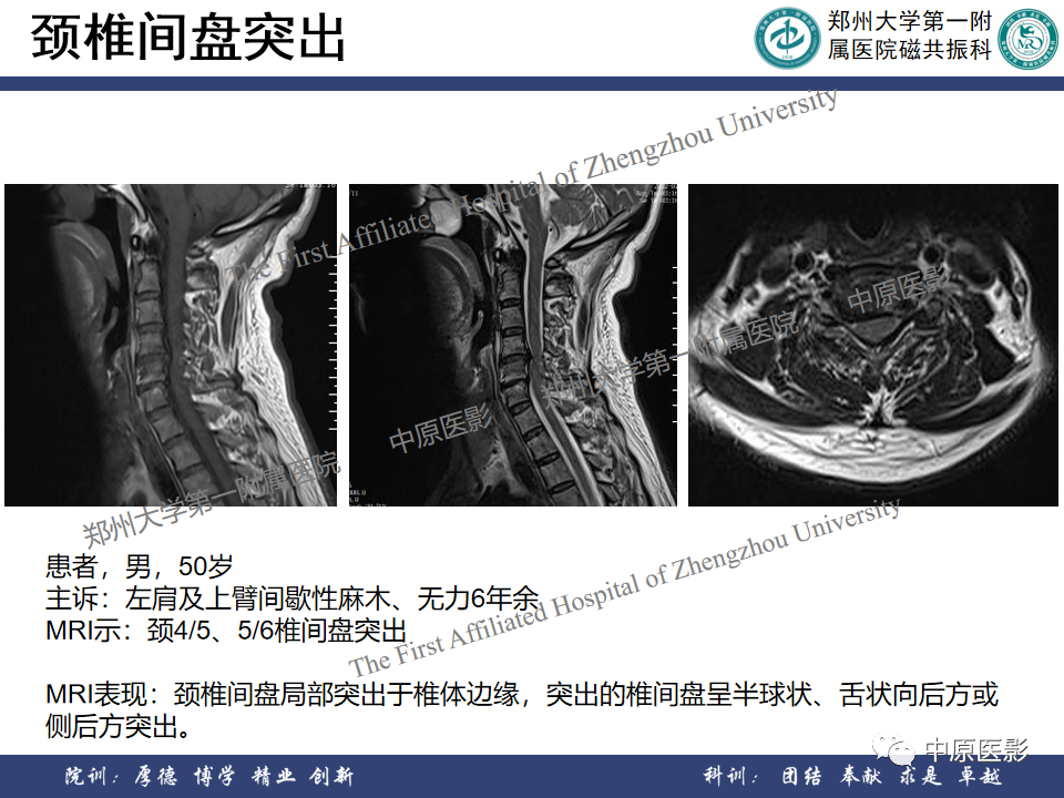 影像PPT - 【PPT】磁共振在颈椎病中的应用-25
