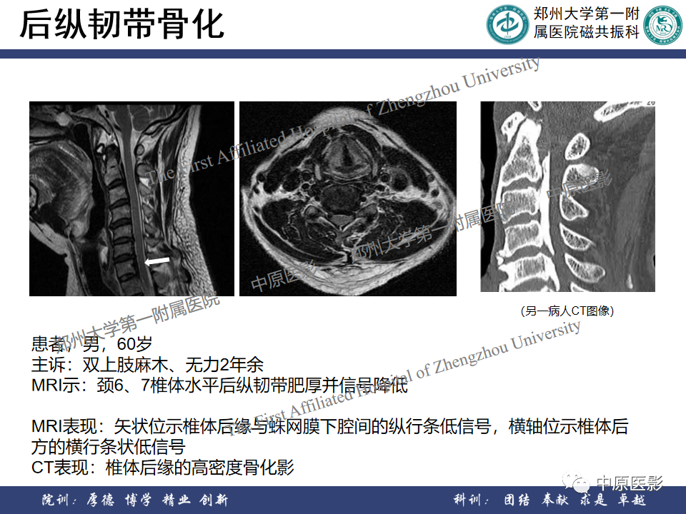 影像PPT - 【PPT】磁共振在颈椎病中的应用-26