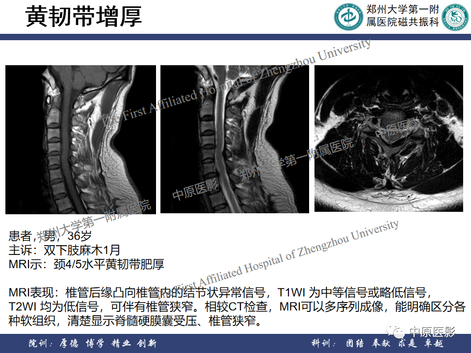 影像PPT - 【PPT】磁共振在颈椎病中的应用-27
