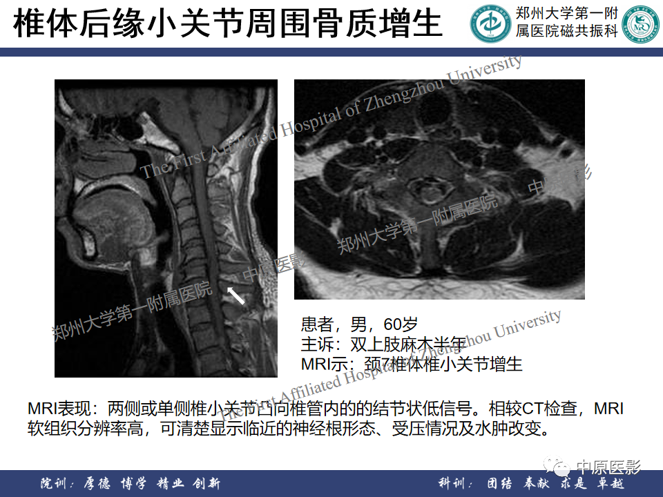 影像PPT - 【PPT】磁共振在颈椎病中的应用-28