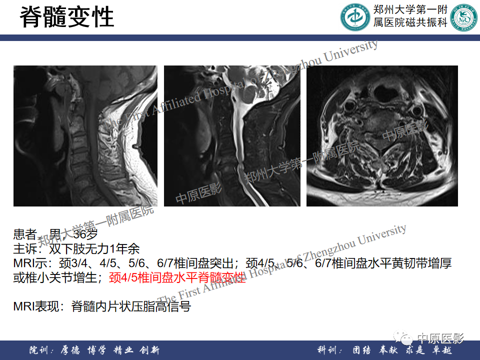 影像PPT - 【PPT】磁共振在颈椎病中的应用-29