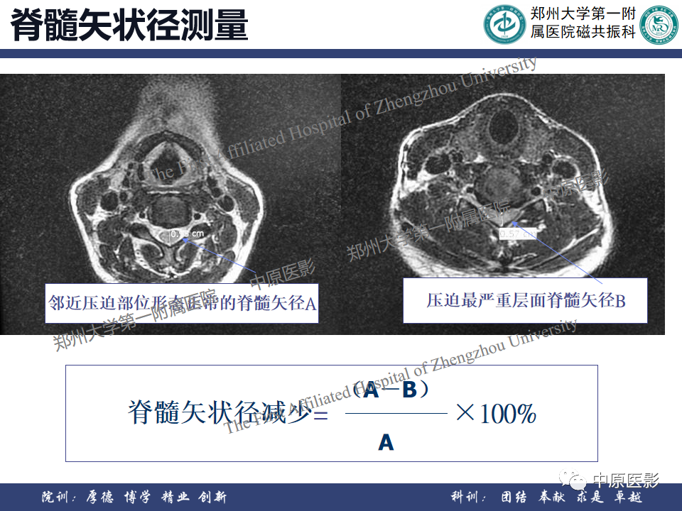 影像PPT - 【PPT】磁共振在颈椎病中的应用-32