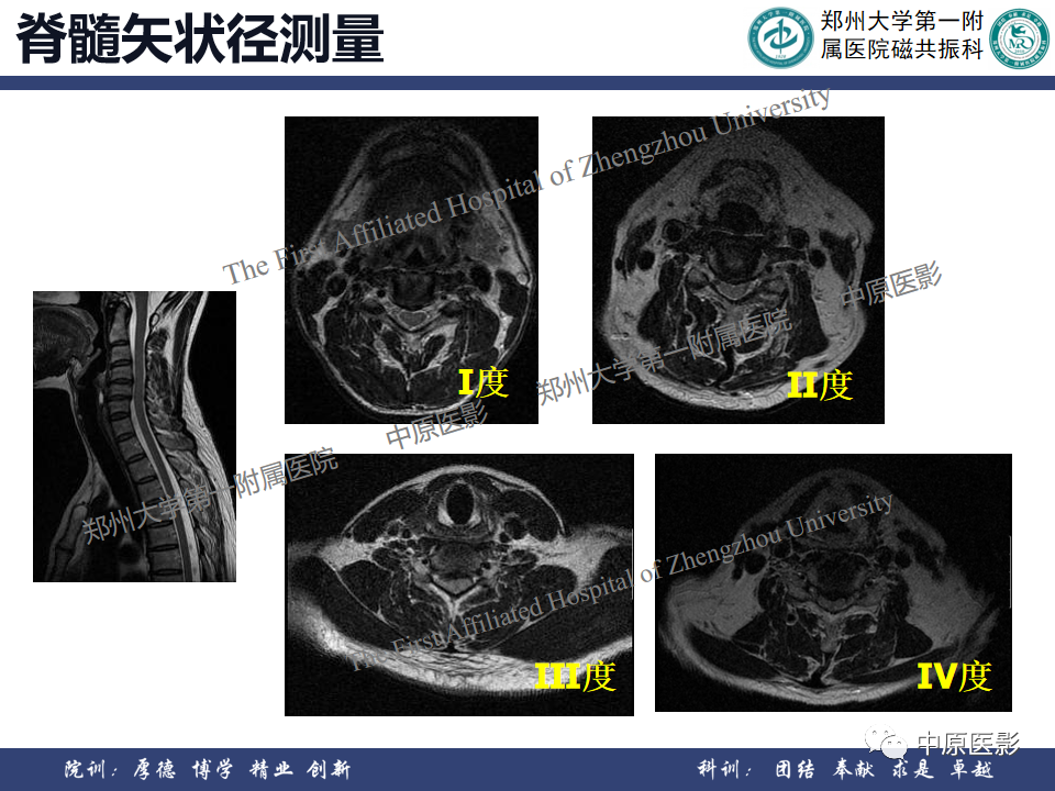 影像PPT - 【PPT】磁共振在颈椎病中的应用-34