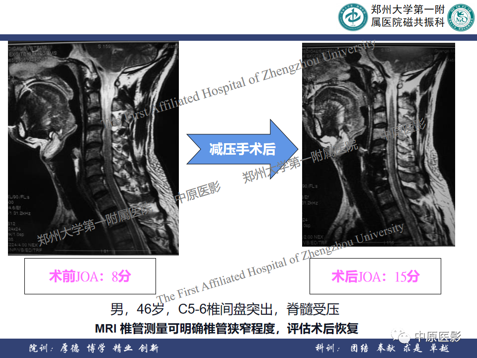 影像PPT - 【PPT】磁共振在颈椎病中的应用-36